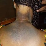 Dépigmentation : quand la quête d’une peau plus claire expose à des risques sanitaires